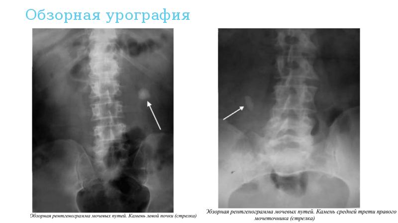 На качестве изображения мочевых путей при экстренной урографии отражается