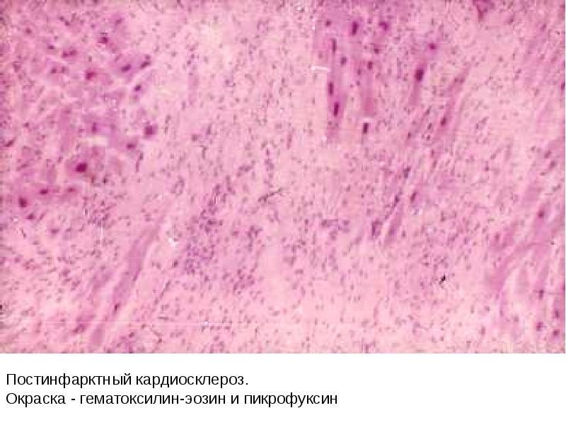 Постинфарктный кардиосклероз что это. Гематоксилин Вейгерта (а). Кардиосклероз окраска пикрофуксином. Гематоксилин пикрофуксин. Окраска гематоксилин пикрофуксин.