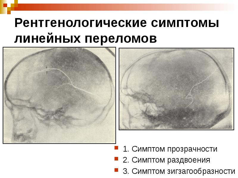 Сосудистый рисунок костей свода черепа усилен