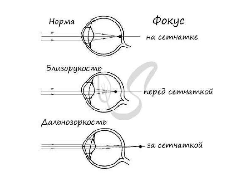 Фокус изображения при миопии