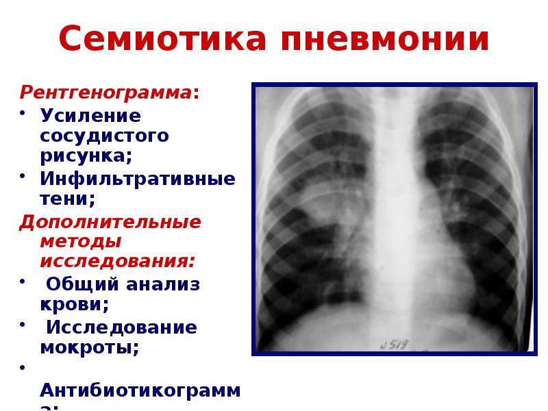 Усиление сосудистого рисунка легких