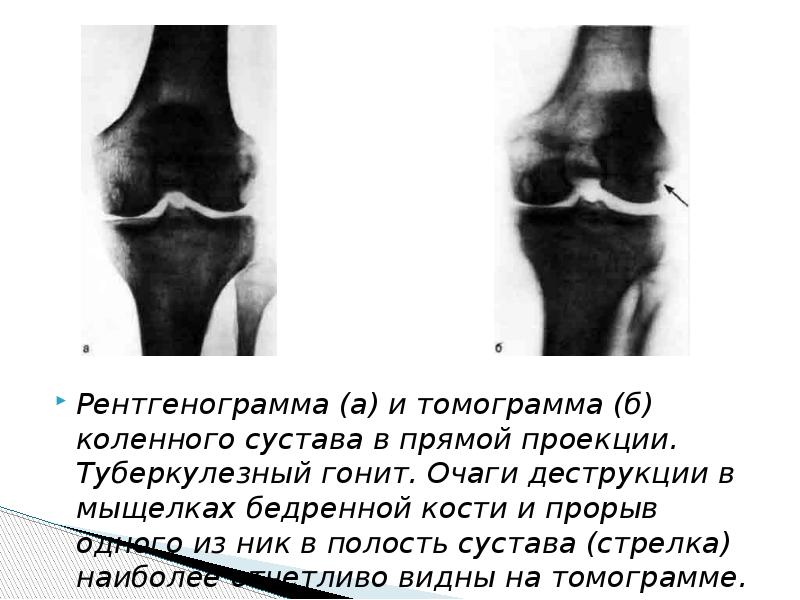 Туберкулез суставов презентация