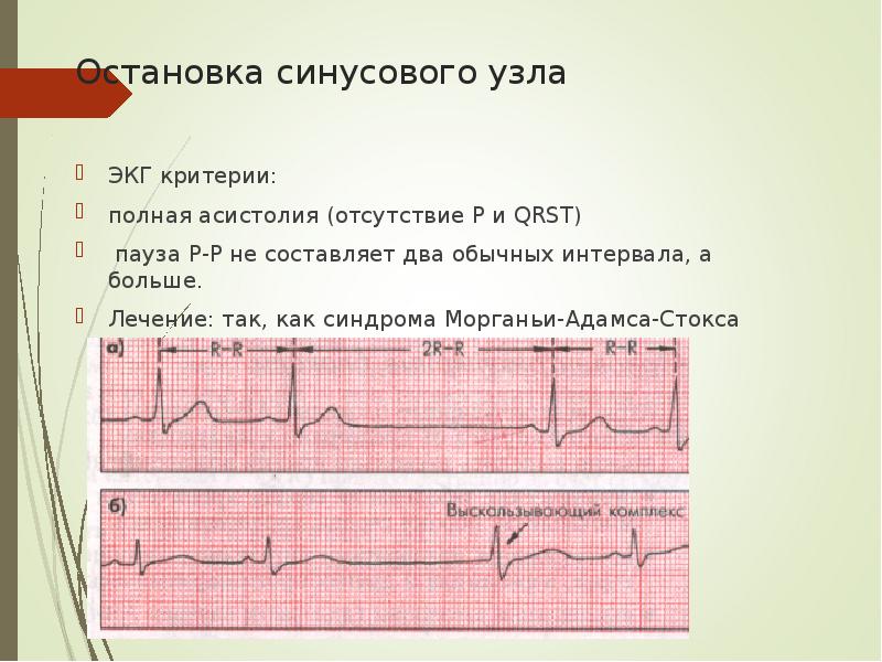 Блок схема аритмии сердца