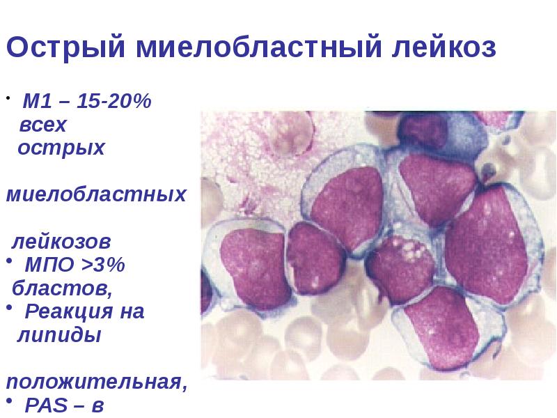 Созылмалы миелолейкоз презентация