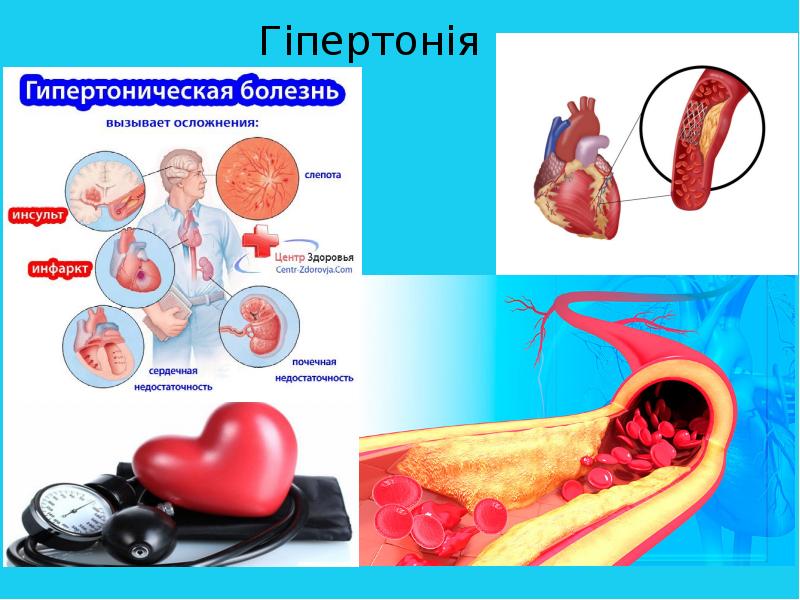 Гiпертонiя Гiпертонiя