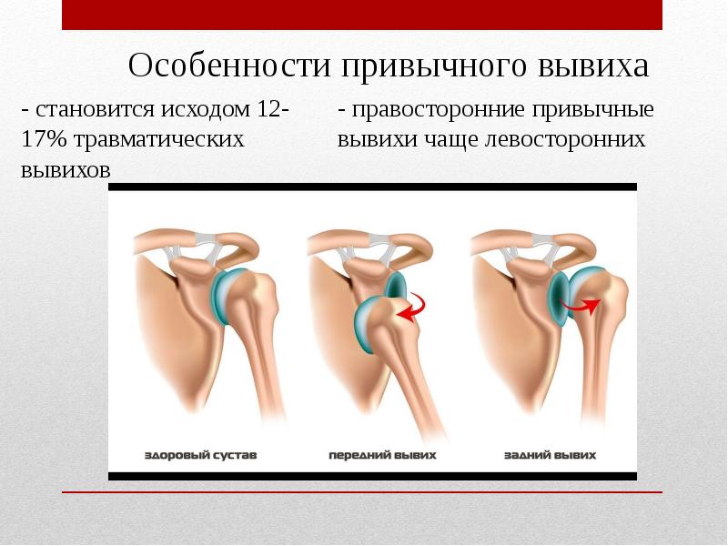 Вывих симптомы. Привычный вывих плечевого сустава травма. Передний вывих головки плечевой кости. Привычный подвывих плечевого сустава. Верхний вывих плечевого сустава.