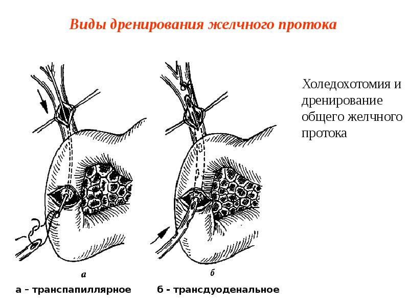 Виды дренирования желчного протока Виды дренирования желчного протока