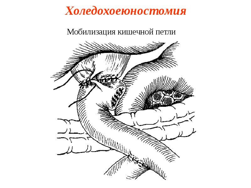 Холедохоеюностомия Холедохоеюностомия