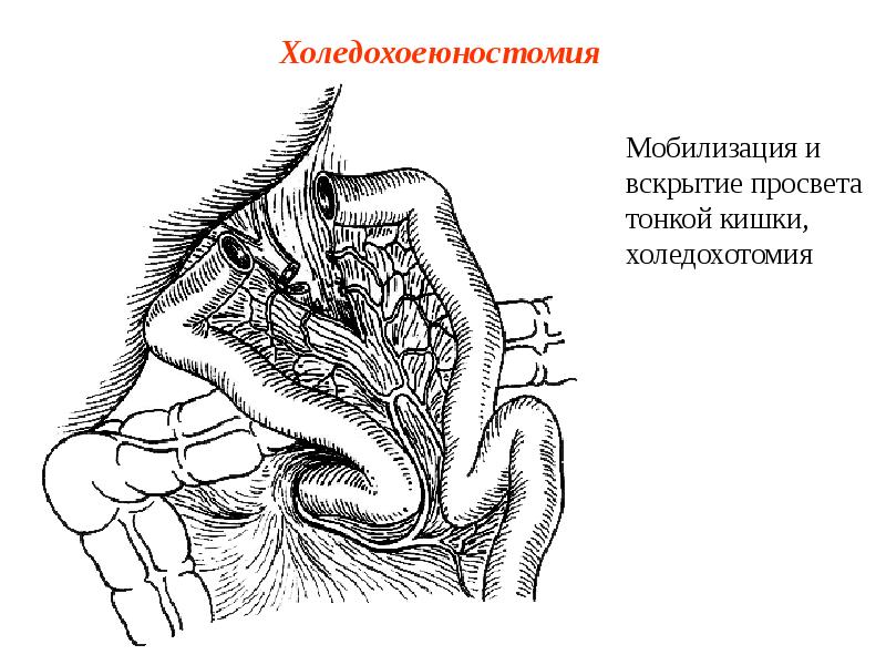 Холедохоеюностомия Холедохоеюностомия