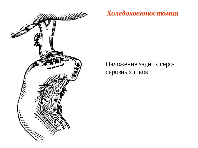 Холедохоеюностомия Холедохоеюностомия