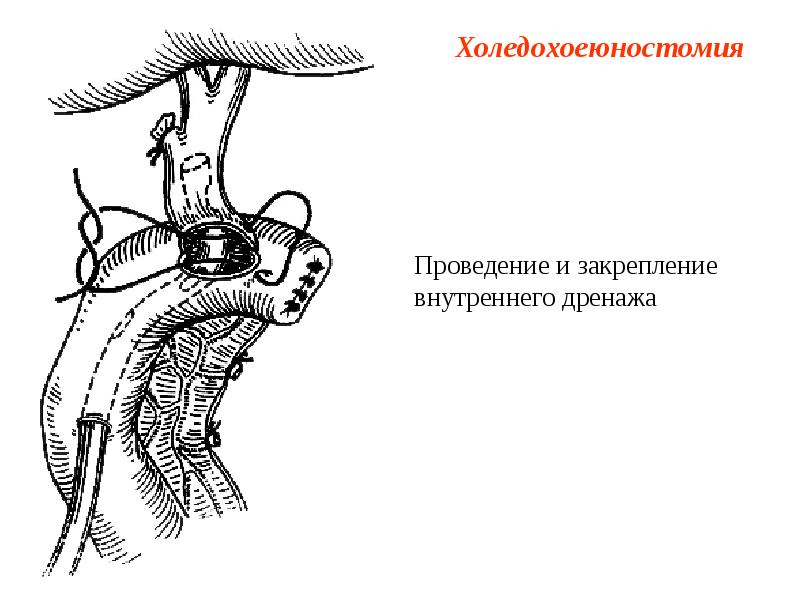 Холедохоеюностомия Холедохоеюностомия