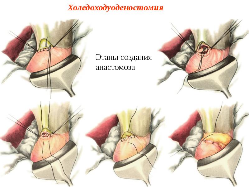 Холедоходуоденостомия Холедоходуоденостомия