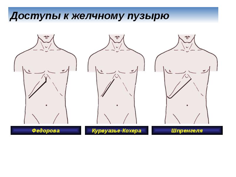 Доступы к желчному пузырю Доступы к желчному пузырю
