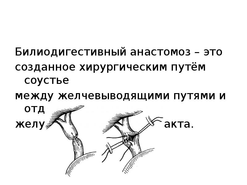 Билиодигестивный анастомоз – это
созданное хирургическим путём соустье
между желчевыводящими Билиодигестивный анастомоз – это
созданное хирургическим путём соустье
между желчевыводящими