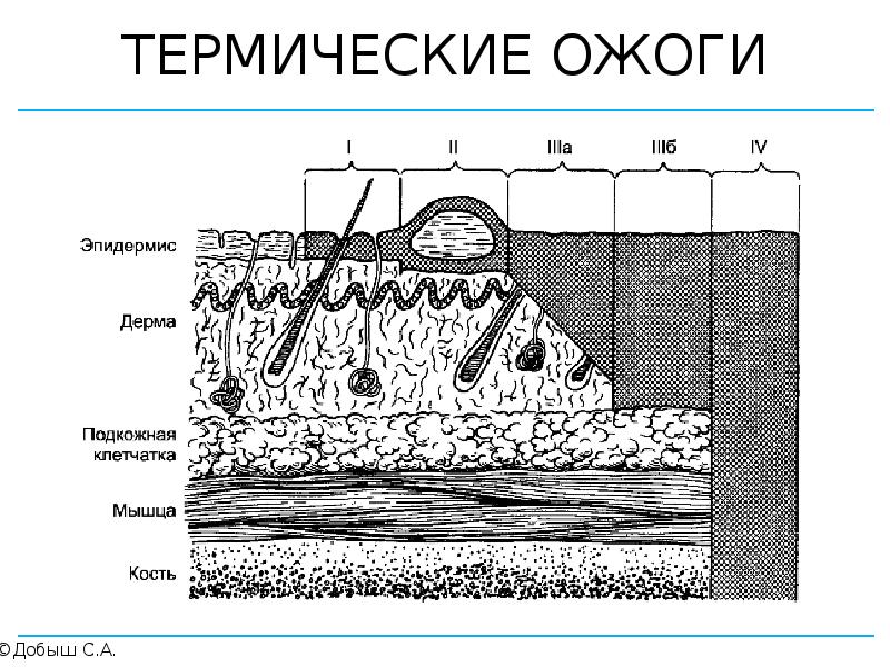 Термические поражения травматология презентация