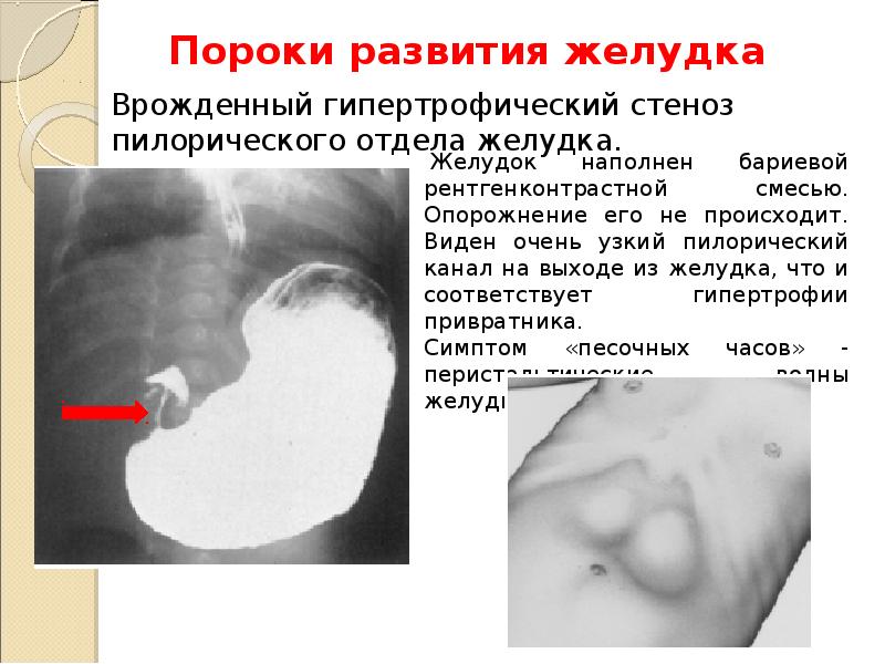 Врожденный туберкулез презентация