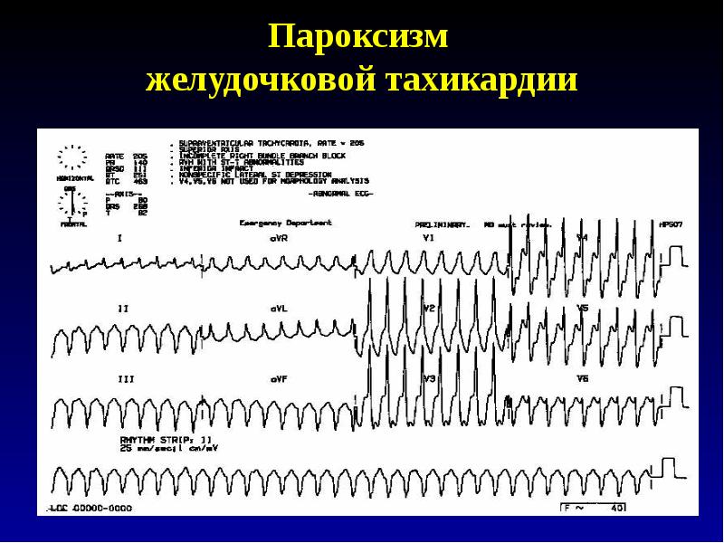 Пароксизмальная желудочковая тахикардия карта вызова смп