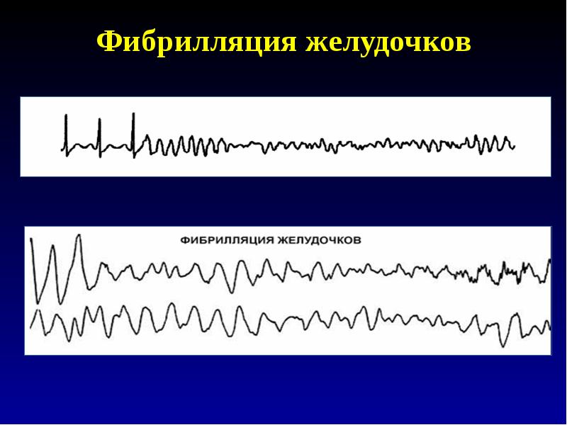 Трепетание и фибрилляция желудочков презентация