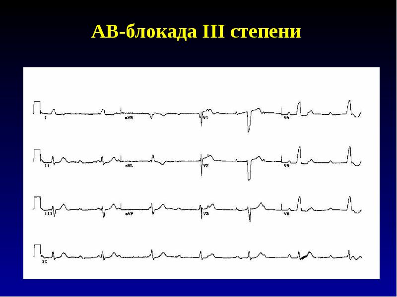 Ав блокада степени. АВ блокада 3 степени. Av-блокада III степени. Преходящая АВ блокада 3 степени. Критерии АВ блокады 3 степени.