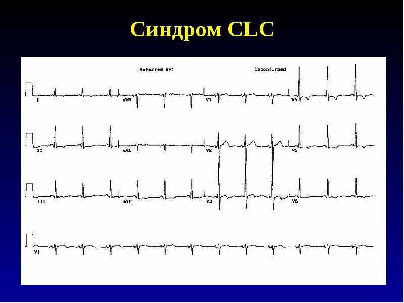 Кардиограмма синдромов. Экг при синдроме clc. Дельта волна на экг при впв. Синдром clc (клерка-леви-кристеско) на экг. Синдром бругада тип 2 экг.