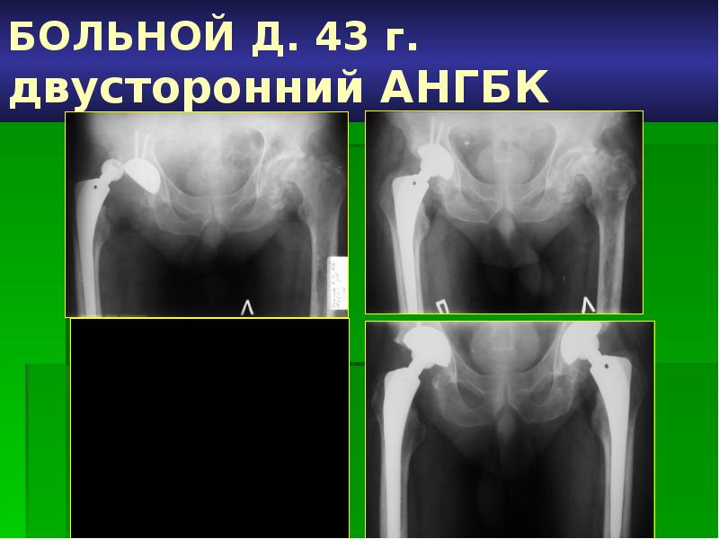 Асептический некроз бедренной кости. Степени асептического некроза головки бедренной кости на кт. Асептический некроз головки бедренной кости классификация рентген. Классификация асептического некроза головки бедренной кости. Асептический некроз головки бедренной кости стадии.