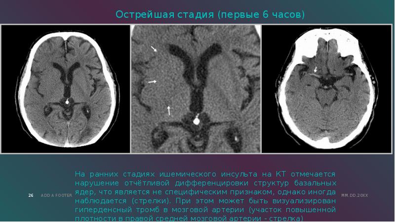 Ишемический инсульт презентация