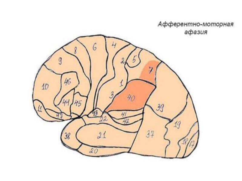 Афферентная моторная афазия нарушения. Очаг поражения при эфферентной моторной афазии. Эфферентная моторная афазия зона поражения. Очаг поражения при афферентной моторной афазии. Афазии схема мозга.