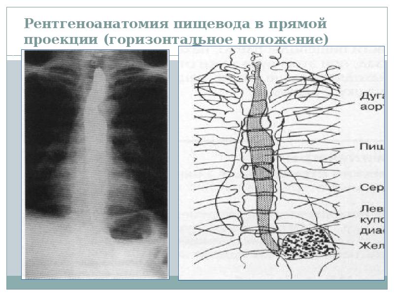 Лучевая диагностика пищевода презентация