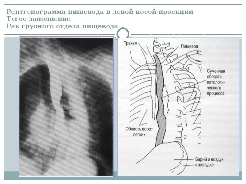 Лучевая диагностика пищевода презентация