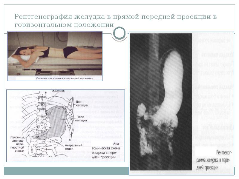 Рентгенография желудка презентация