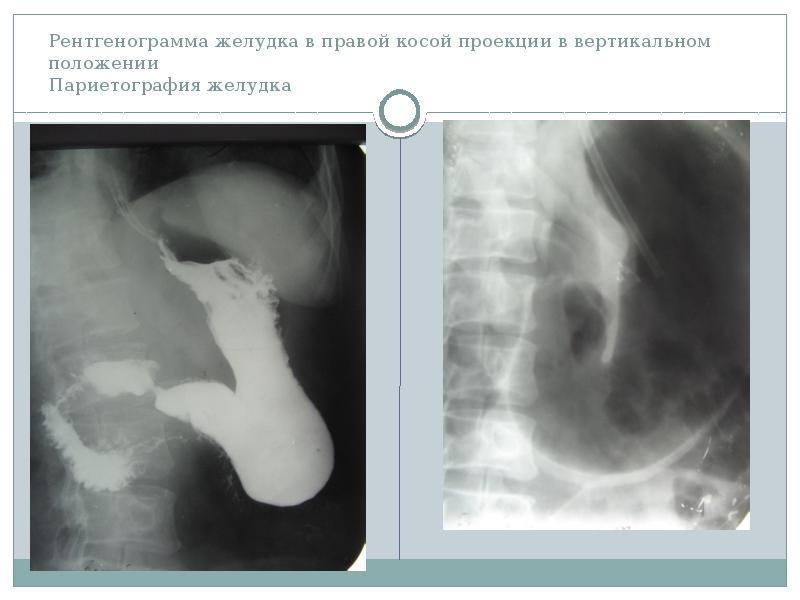 Рентгенография желудка презентация