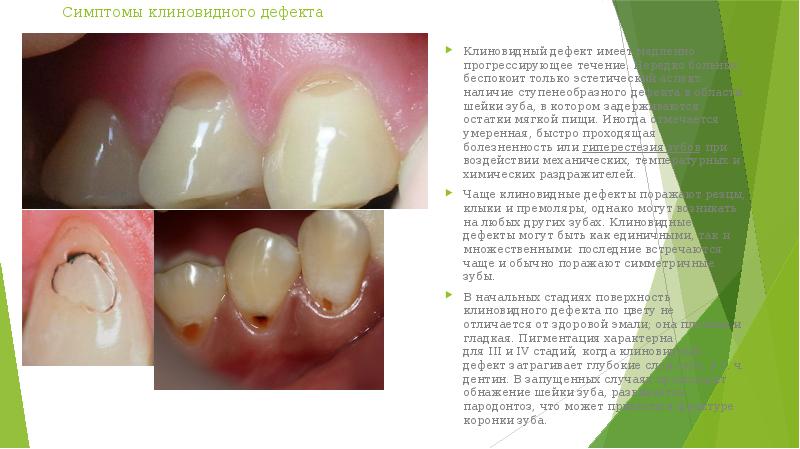 Клиновидный дефект презентация