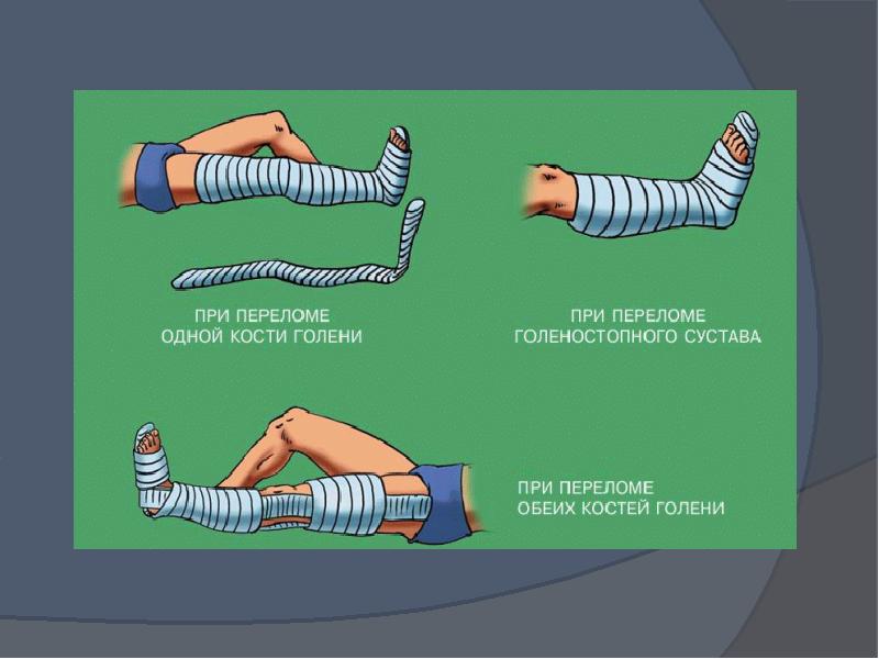 Перелом быстрее. Презентация на тему переломы. Открытый перелом презентация.