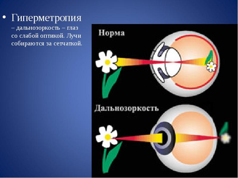 Изображение при гиперметропии фокусируется