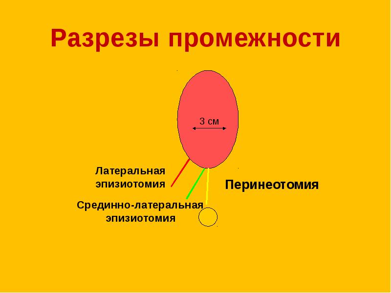 Перинеотомия и эпизиотомия презентация