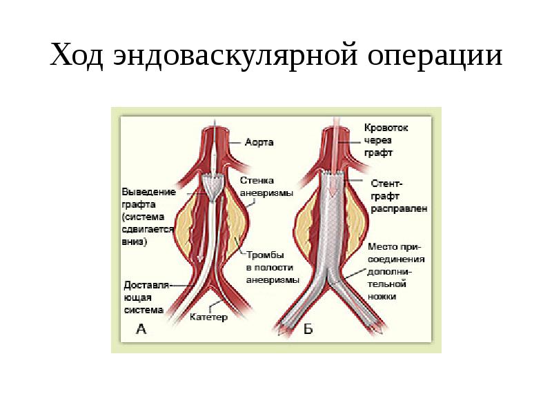 Виды аневризм по строению стенки