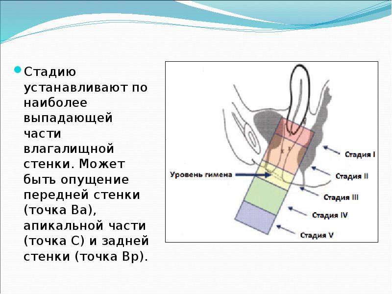 Стадию устанавливают по наиболее выпадающей части влагалищной стенки. Может быть опущение Стадию устанавливают по наиболее выпадающей части влагалищной стенки. Может быть опущение