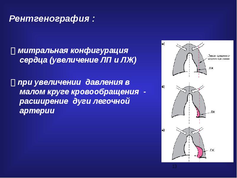 Конфигурация сердца. Митральная конфигурация сердца рентген. Конфигурация сердца при митральном стенозе. Трапециевидная конфигурация сердца рентген. Конфигурация сердца при митральной недостаточности.