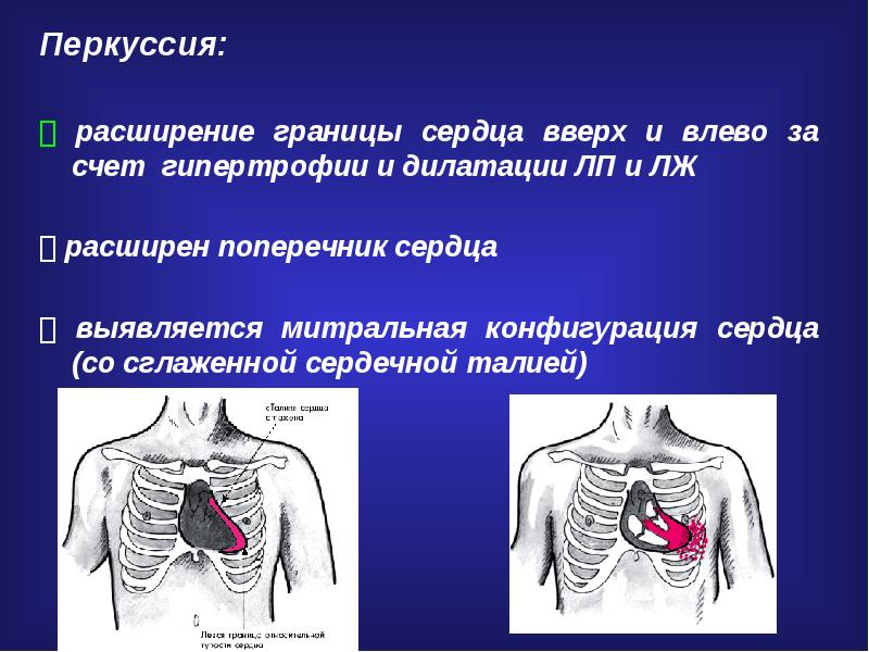 Перкуссия сердца презентация