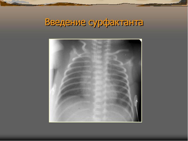 Синдром утечки. Транзиторное тахипноэ новорожденных рентген. Синдром утечки воздуха у новорожденных рентген. Синдром утечки воздуха у новорожденных. Синдром дыхательных расстройств у новорожденных презентация.