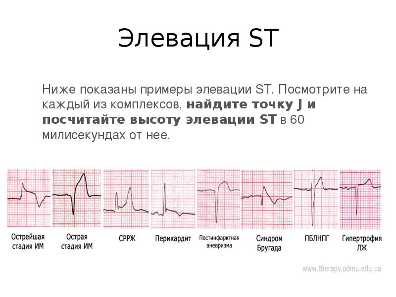 Карта вызова острый инфаркт миокарда с подъемом ст