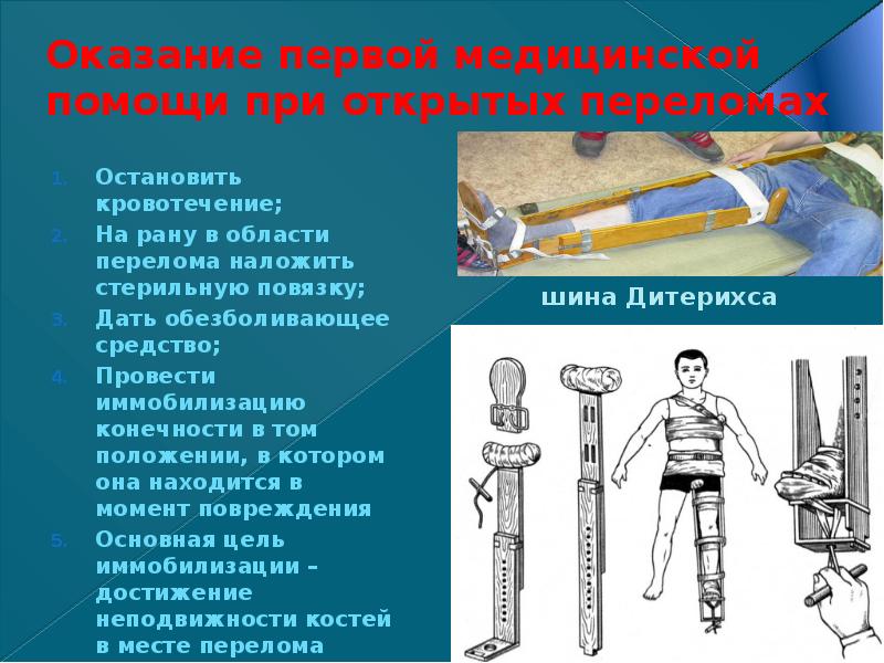 Первая помощь при переломах обж презентация