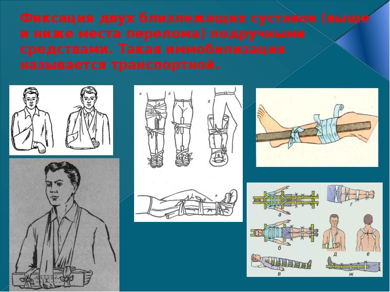 Переломы и вывихи костей предплечья и кисти презентация