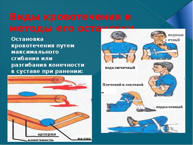 Виды кровотечений схема