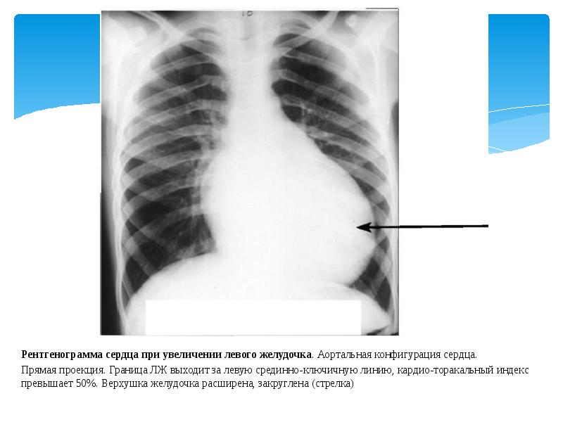 Аортальная конфигурация сердца. Гипертрофия левого желудочка рентген. Аортальная конфигурация сердца рентген. Аортальная недостаточность конфигурация сердца. Гипертрофия правого желудочка сердца рентген.