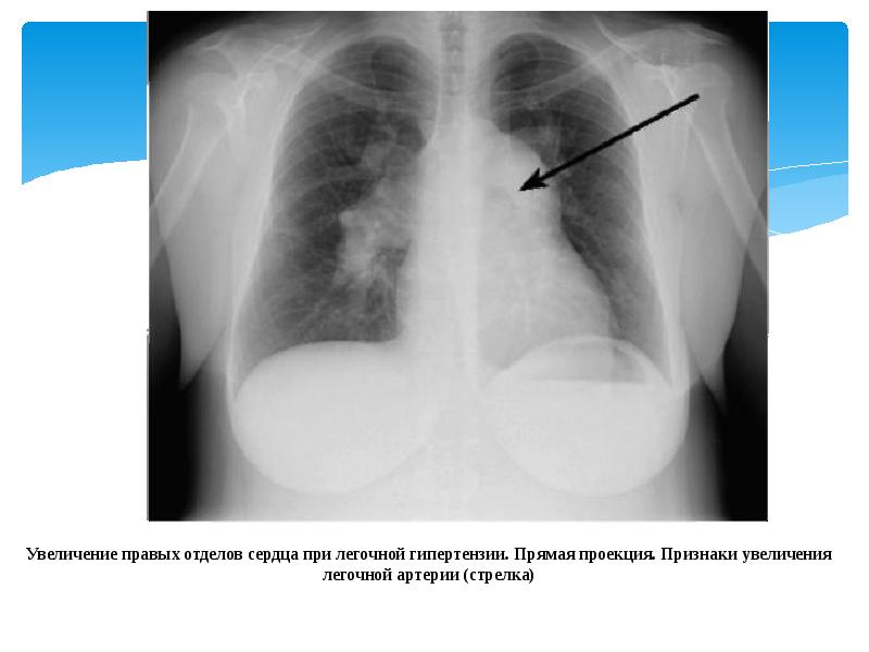 Увеличено правое. Рентгенография при легочной гипертензии. Рентген при легочной гипертензии. Легочная артериальная гипертензия рентген. Рентгенограмма при легочной гипертензии.