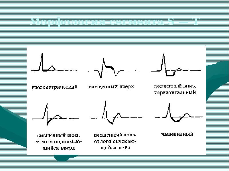 Что такое экг