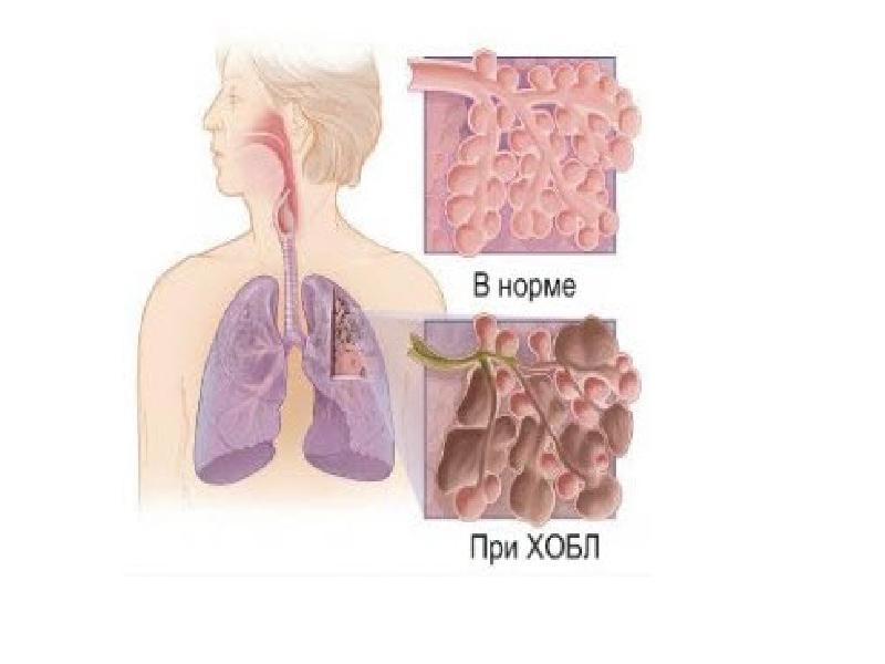 Фиброз что это за болезнь симптомы и лечение у мужчин фото