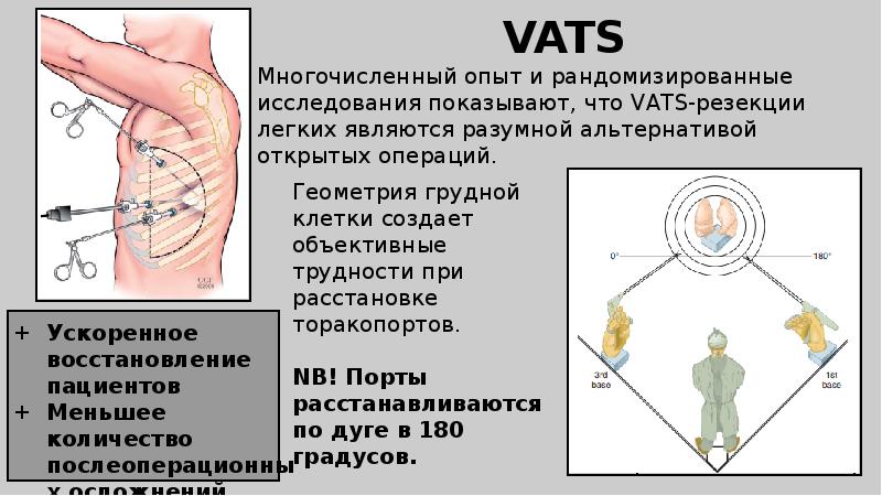 Торакальная хирургия презентация