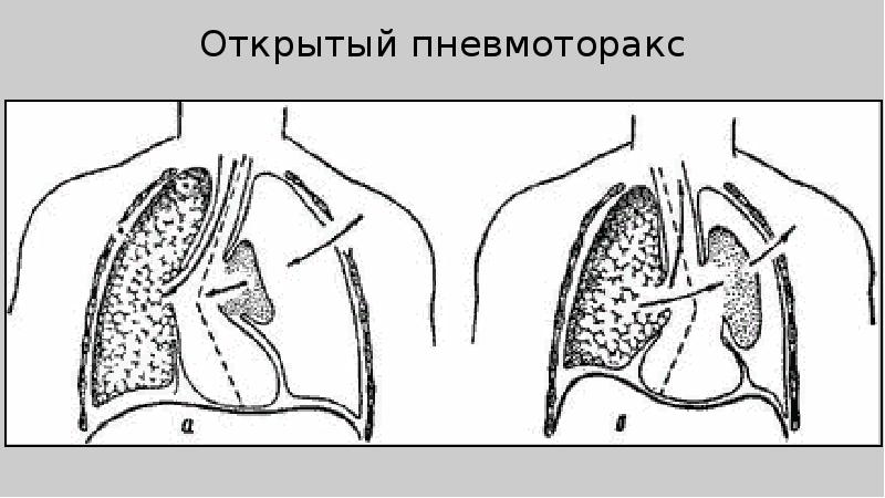 Пневмоторакс хирургия презентация